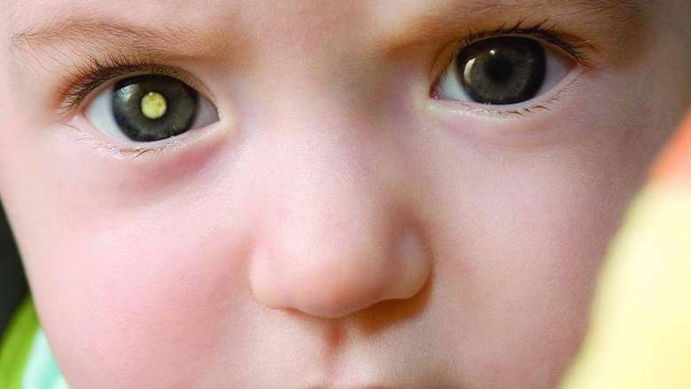 Teste do Olhinho é primeiro passo para identificar doenças oculares