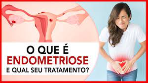 Endometriose: Saiba o que é e qual o tratamento