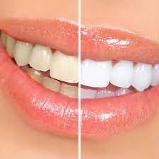 Quer ter dentes mais brancos? Confira 6 maneiras de fazer isso em casa.
